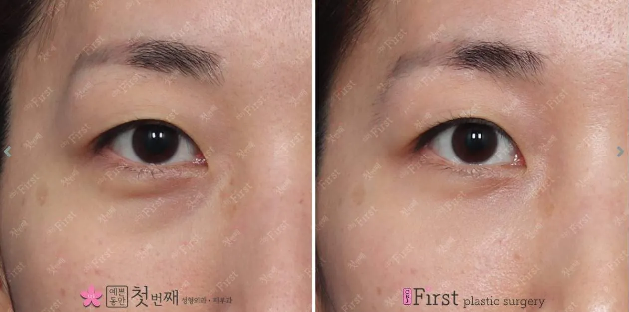 blepharoplasty korea